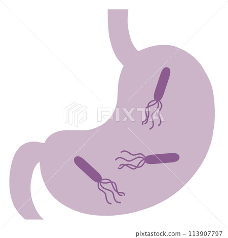 Illustration of a stomach with Helicobacter pylori 113907797