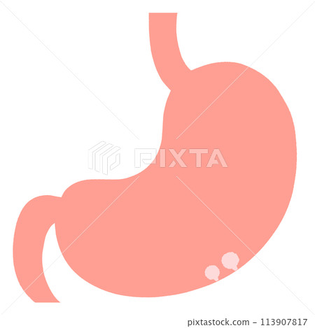 Illustration of a stomach with asymptomatic benign polyps 113907817