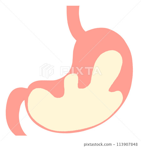 Illustration of hyperacidity Illustration of hyperacidity 113907848