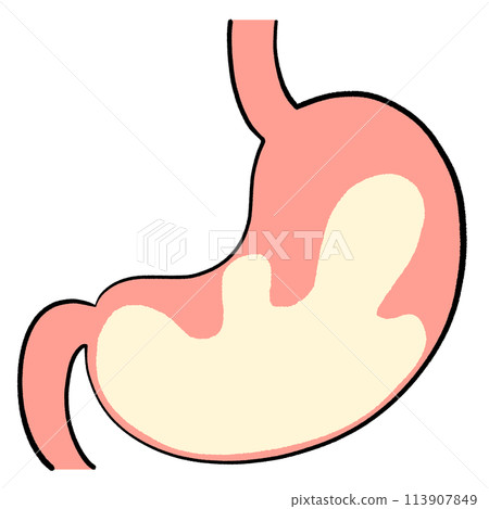 Illustration of hyperacidity Illustration of hyperacidity 113907849