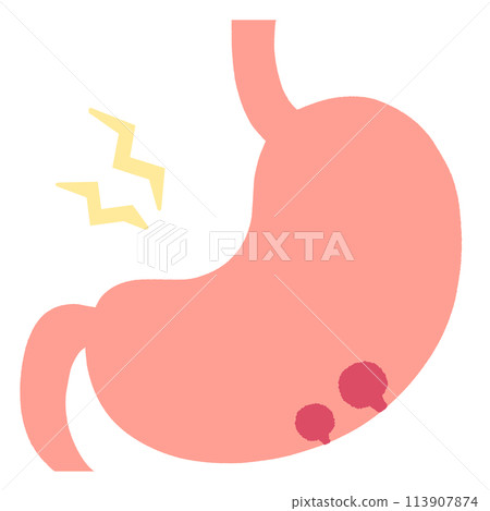 慢性胃炎和息肉胃圖 113907874