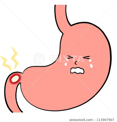 Illustration of duodenal ulcer 113907907