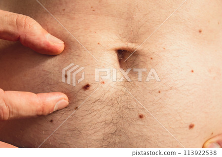 Unrecognizable man showing his birthmarks on skin Close up detail of the bare skin Sun Exposure effect on skin. Health Effects of UV Radiation Male with birthmarks Pigmentation 113922538