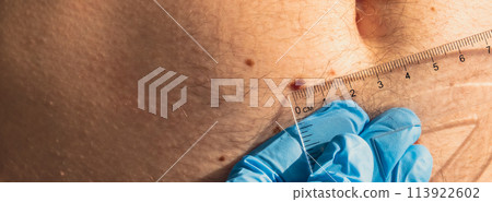 Unrecognizable Doctor in medical gloves examining length and width of benign moles on man skin. Dermatologist checking male birthmarks with ruler Unrecognizable Doctor in medical gloves examining length and width of benign moles on man skin. Dermatologist checking male birthmarks with ruler 113922602