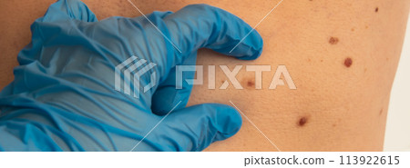 Dermatologist checking male birthmarks for changing size. Annual rechecking. Doctor in medical gloves examining man skin mole. Self care preventing cancer procedure. Protection treatment. Imperfection 113922615