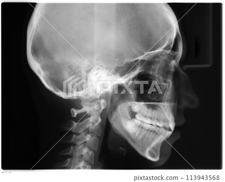 X-ray picture of skull side (Lateral, LAT) view. Human skull, jaw and neck on black background. Woman head. X-ray picture of skull side (Lateral, LAT) view. Human skull, jaw and neck on black background. Woman head. 113943568