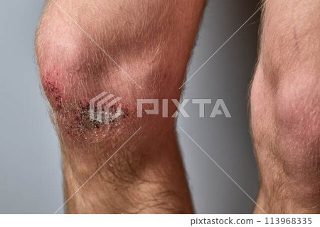 the wound on the knee was treated with hydrogen peroxide 113968335