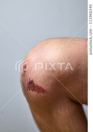 scratch, knee wound on a man's knee scratch, knee wound on a man's knee 113968340