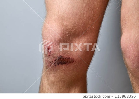 scratch, knee wound on a man's knee scratch, knee wound on a man's knee 113968350