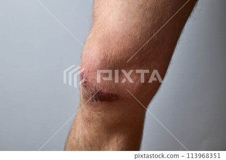 scratch, knee wound on a man's knee scratch, knee wound on a man's knee 113968351