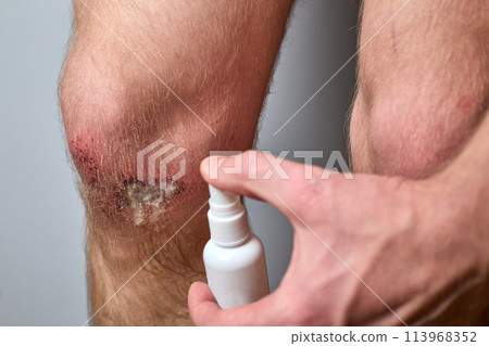the wound on the knee was treated with hydrogen peroxide 113968352