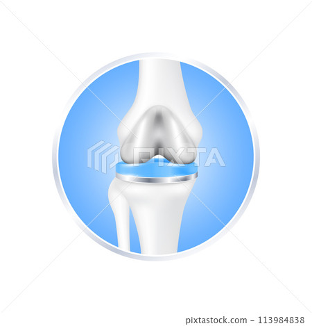 label aluminum. Knee replacement surgery total implant for treatment relieve arthritis, after joint damaged. Leg bone cartilage. Isolated on white background for product design. Realistic 3d vector. label aluminum. Knee replacement surgery total implant for treatment relieve arthritis, after joint damaged. Leg bone cartilage. Isolated on white background for product design. Realistic 3d vector. 113984838