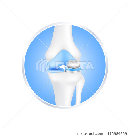 label aluminum. Knee replacement surgery partial implant for treatment relieve arthritis, after joint damaged. Leg bone cartilage. Isolated on white background for product design. Realistic 3d vector. 113984839