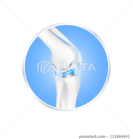 label aluminum. Knee replacement surgery total implant for treatment relieve arthritis, after joint damaged. Leg bone and side. Isolated on white background for product design. Realistic 3d vector. label aluminum. Knee replacement surgery total implant for treatment relieve arthritis, after joint damaged. Leg bone and side. Isolated on white background for product design. Realistic 3d vector. 113984841