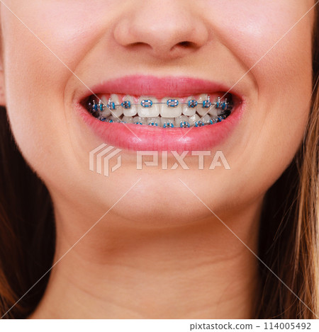 Woman showing her teeth with braces Woman showing her teeth with braces 114005492