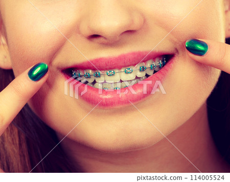 Woman showing her teeth with braces Woman showing her teeth with braces 114005524