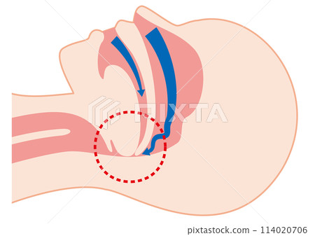 Mechanism of sleep apnea syndrome 114020706