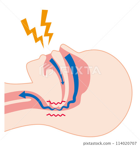 The mechanism of snoring 114020707