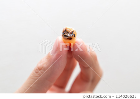 一個人有蛀牙的恆牙的照片。已拔除的腐爛智齒的照片。 一個人有蛀牙的恆牙的照片。已拔除的腐爛智齒的照片。 114026625