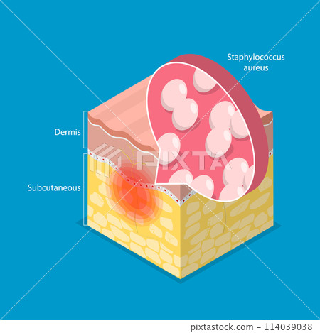 3D Isometric Flat Vector Illustration of Cellulitis, Bacterial Infection 114039038
