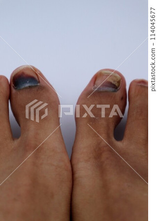 兩隻腳指甲受傷的特寫 114045677