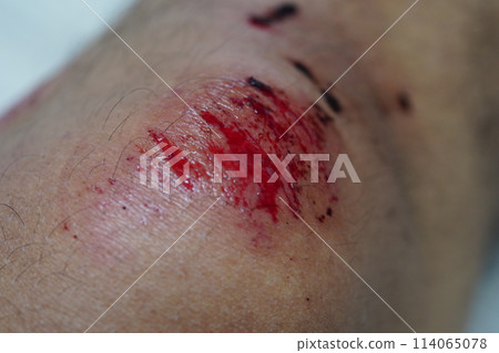 wound 114065078