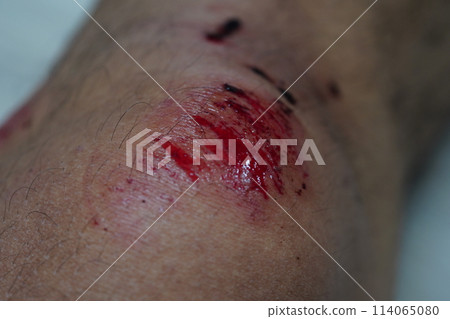 wound 114065080