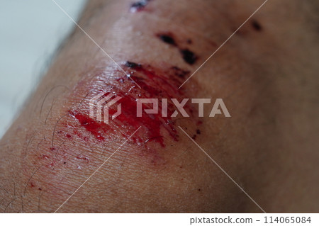 wound 114065084