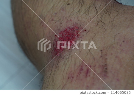 wound 114065085