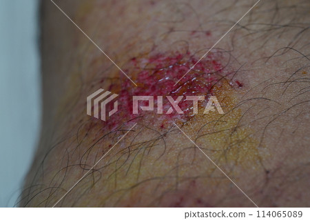 wound 114065089