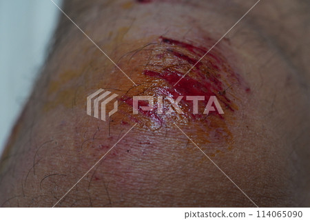 wound 114065090
