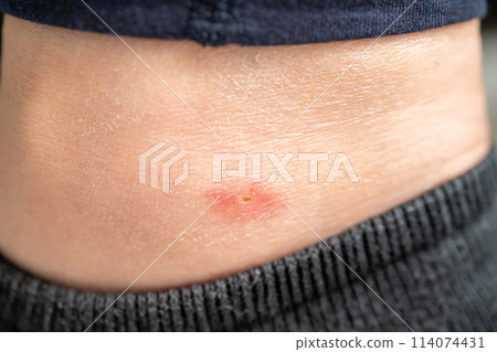 Insect bites Insect bites 114074431