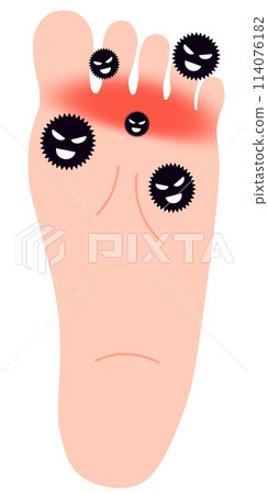 Athlete's foot Athlete's foot 114076182