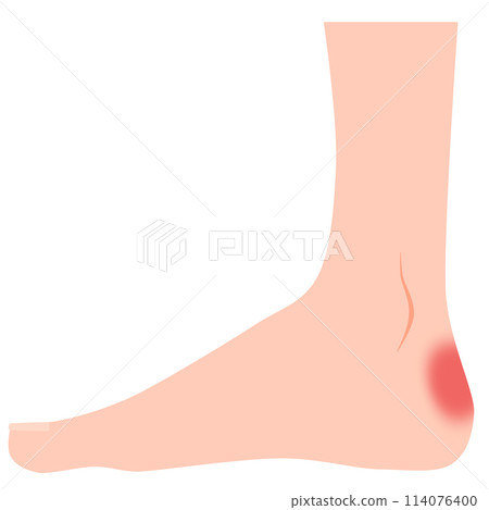 腳起泡 腳起泡 114076400