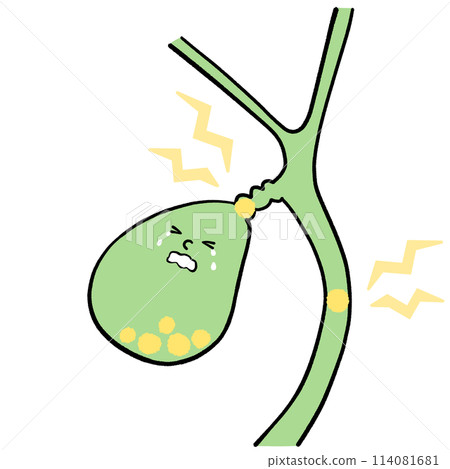 Illustration of the gallbladder with gallstones Illustration of the gallbladder with gallstones 114081681