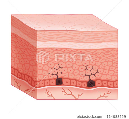 Cross-section of skin (mechanism of age spots) Cross-section of skin (mechanism of age spots) 114088539