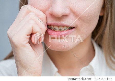 Close-up portrait of a red-haired girl suffering from pain due to braces. Young woman corrects bite with orthodontic appliance. Close-up portrait of a red-haired girl suffering from pain due to braces. Young woman corrects bite with orthodontic appliance. 114090182