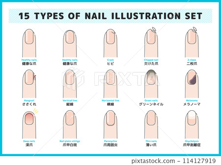 Illustration set of nail diseases, symptoms, injuries, hangnails, inflammation, etc. Illustration set of nail diseases, symptoms, injuries, hangnails, inflammation, etc. 114127919