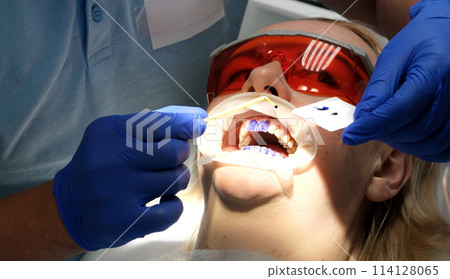 professional teeth cleaning in a dental clinic, removing stones and plaque, applying paint to teeth so that a layer of stones is visible, special newest devices in dentists, blue gloves, blue suits 114128065