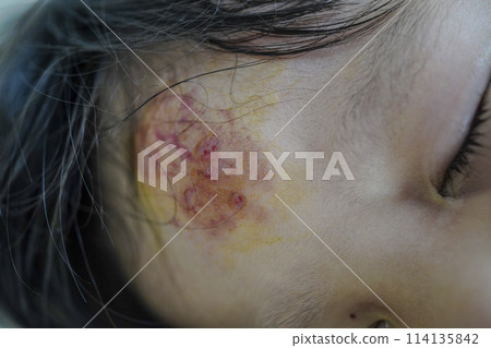 傷口 傷口 114135842