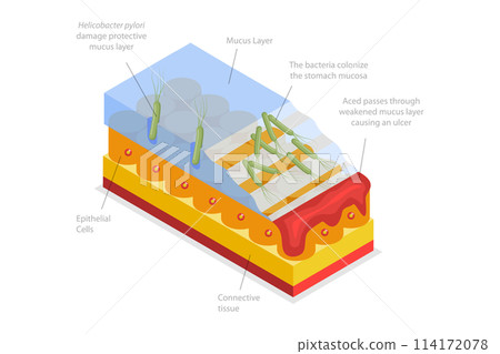 3D Isometric Flat  Conceptual Illustration of Peptic Ulcer, Digestive Tract Disorder 114172078
