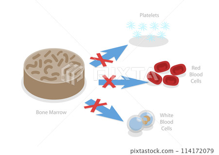 3D Isometric Flat Conceptual Illustration of Aplastic Anemia, Blood Disorder Causing Low Blood Cell Production 3D Isometric Flat Conceptual Illustration of Aplastic Anemia, Blood Disorder Causing Low Blood Cell Production 114172079