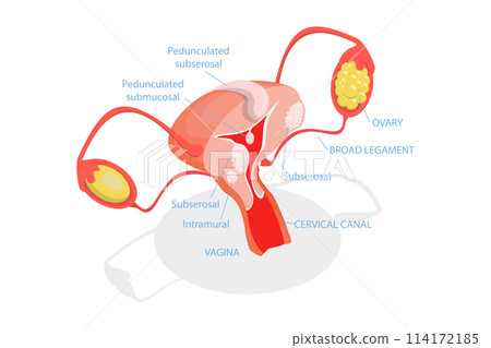 3D Isometric Flat  Conceptual Illustration of Types Of Uterine Fibroids, Human Anatomy 114172185