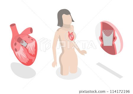 3D Isometric Flat  Conceptual Illustration of Transcutaneous Aortic Valve Replacement - TAVR, Minimally Invasive Surgery 114172196