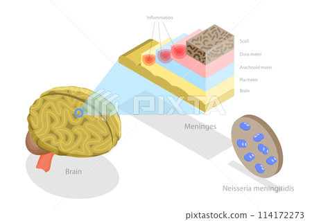 3D Isometric Flat  Conceptual Illustration of Meningitis, Human Brain and Meningococcal Bacteria 114172273