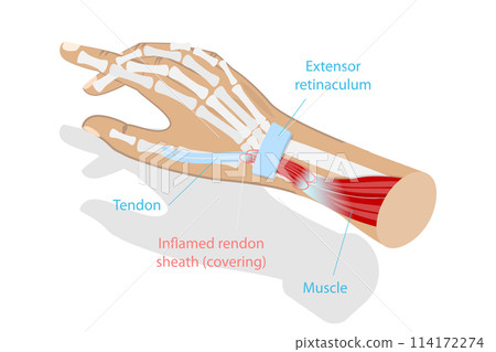 3D Isometric Flat  Conceptual Illustration of De Quervain Syndrome, Occupational Disease of the Hand 114172274