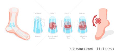 3D Isometric Flat  Conceptual Illustration of Grades Of Sprain, Ankle Problem 114172294