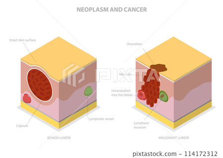 3D Isometric Flat  Conceptual Illustration of Neoplasm And Cancer, Tumor Development 114172312