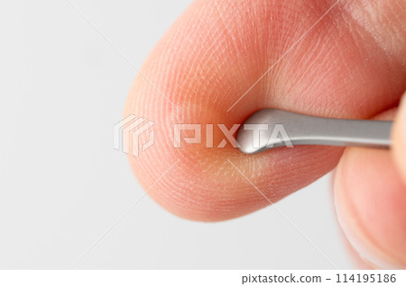 Damaged skin on finger with blister Damaged skin on finger with blister 114195186