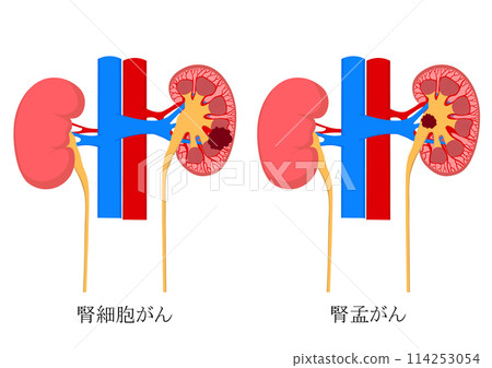 腎細胞癌和腎癌 114253054